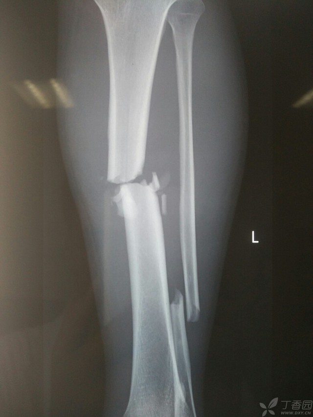 科技重塑脛腓骨骨折康復之旅，引領(lǐng)未來體驗新篇章