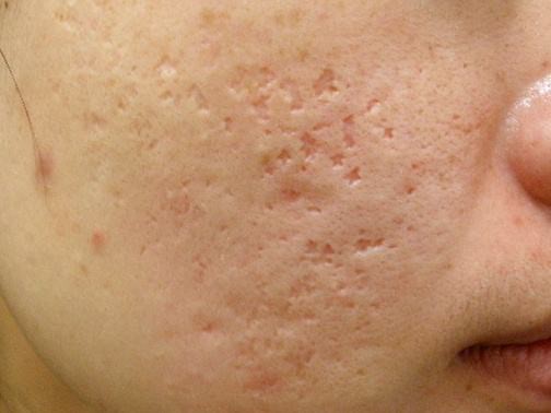 最新痘坑撫平神器，科技重塑肌膚之美，自信生活從此開始