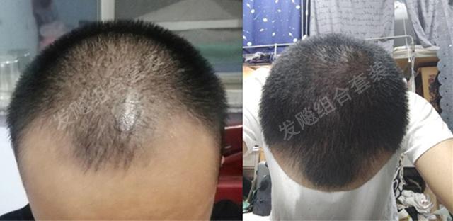 治愈脫發(fā)最新重大突破，重塑自信，希望之光再現(xiàn)